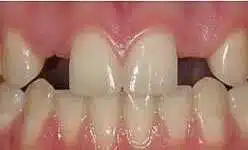 Before/After Bernstein Orthodontics