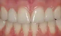 Before/After Bernstein Orthodontics