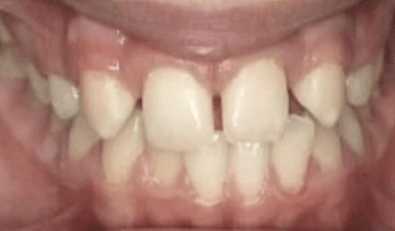 Before/After Bernstein Orthodontics