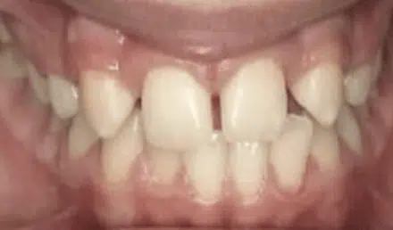 Before/After Bernstein Orthodontics