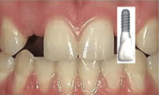Before/After Bernstein Orthodontics