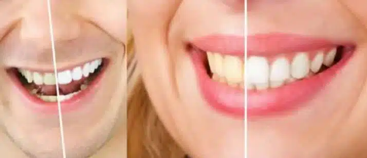 Side by side pictures of teeth bleaching