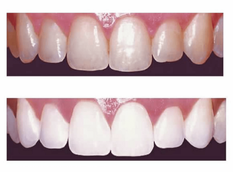 Before and after