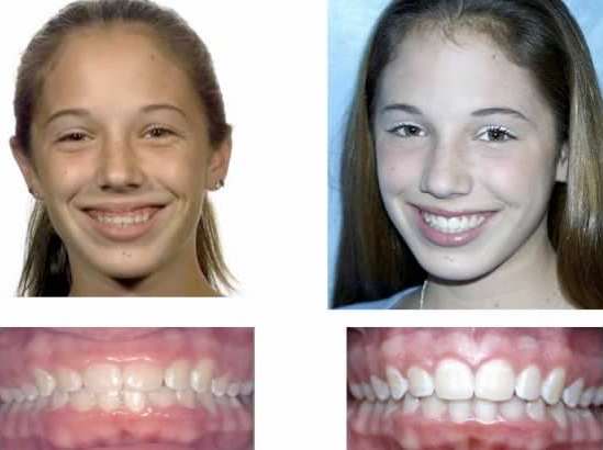 Before and after contouring gums