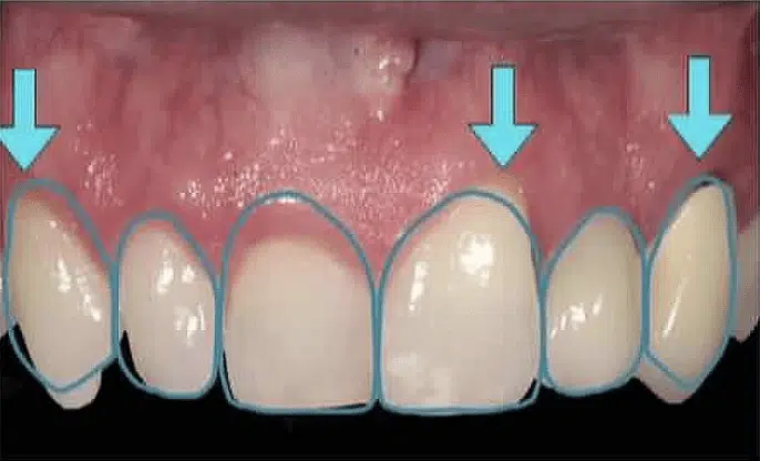 Example of gum line contouring mapping