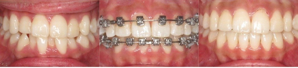 SAP-Placement-Teeth Bracket placement for SAP smile before during and after