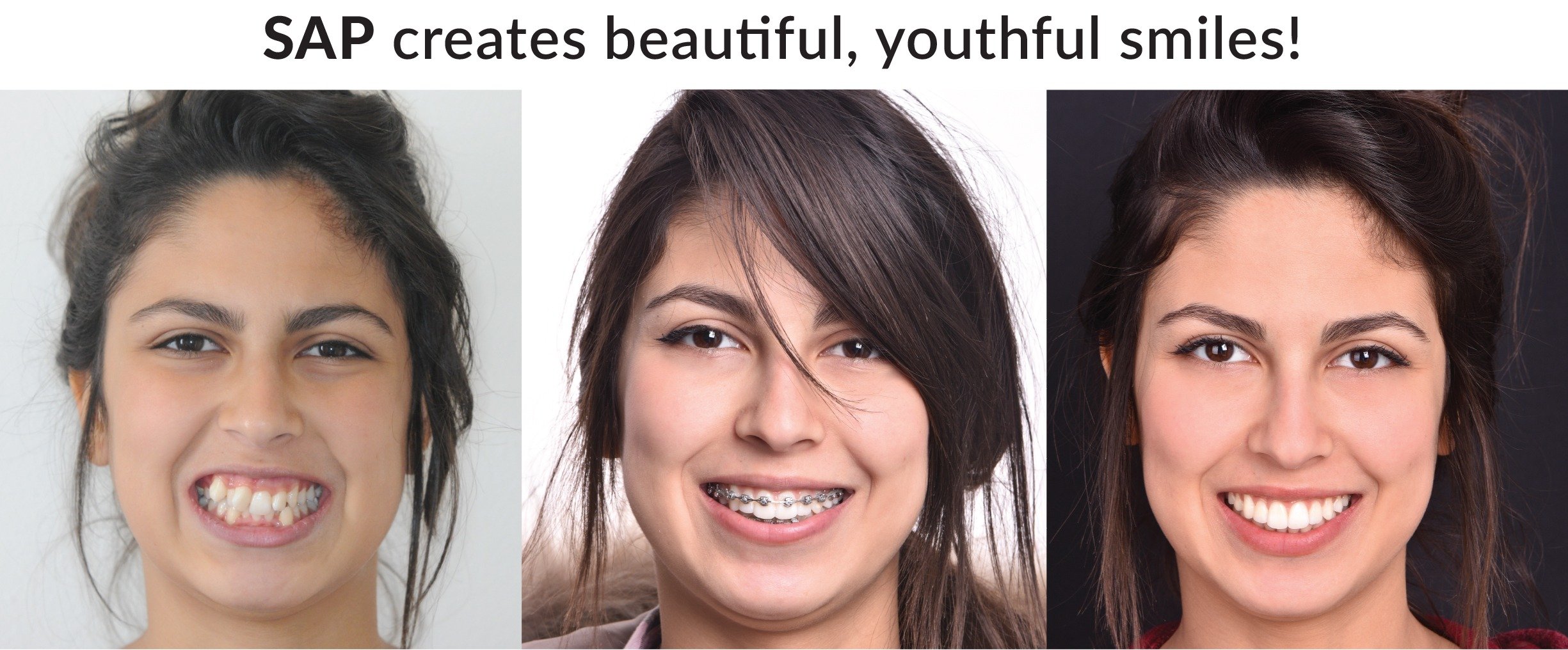 SAP-Smile-Creation SAP smile creation progress before, during, and after