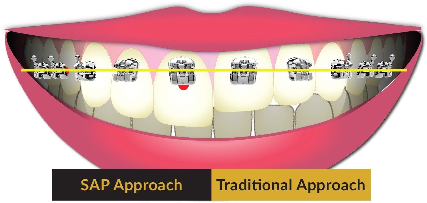 SAP-vs-Tradional-Illustration (1) SAP versus traditional smile illustration