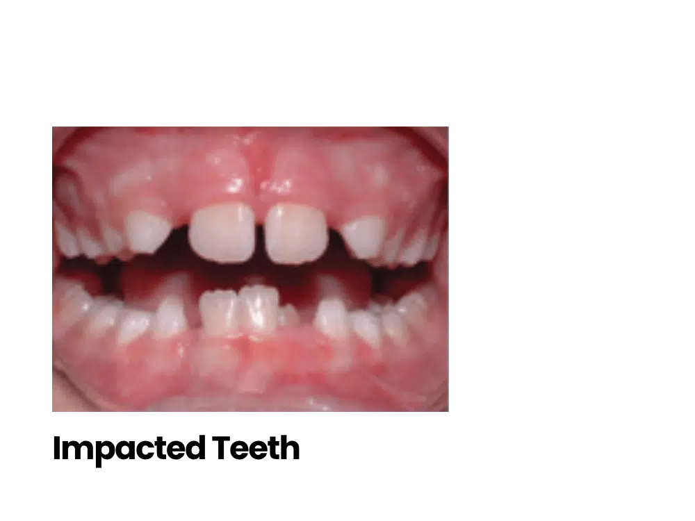 Children’s Orthodontics - Bernstein Orthodontics - Treatment