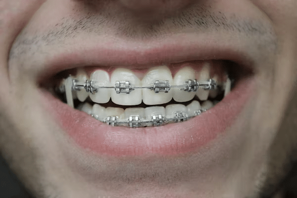 Keeping teeth clean with braces