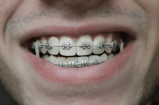 Self-Ligating Braces