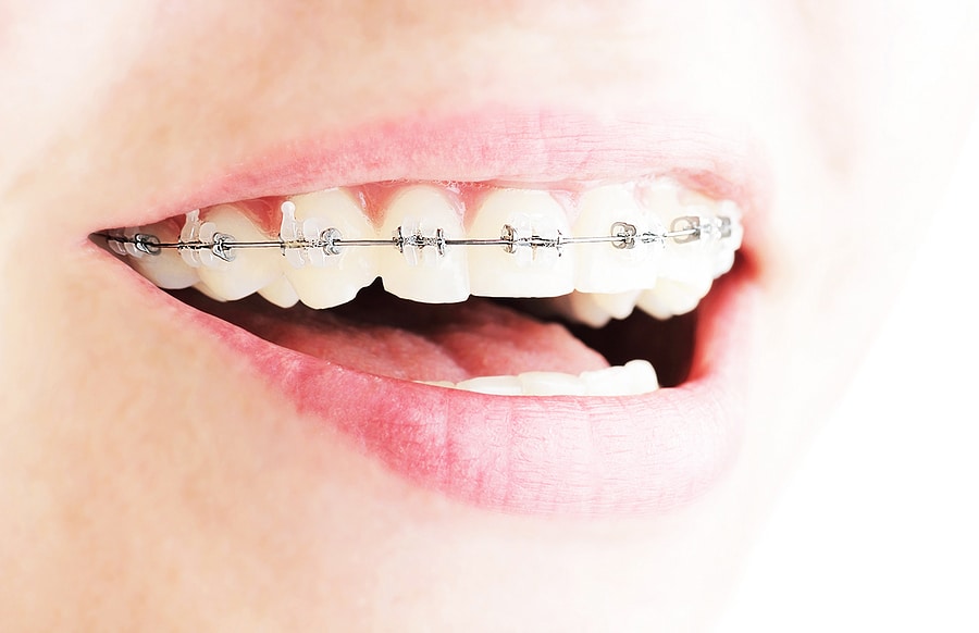 Extreme close-up of a person smiling with clear ceramic and metal braces on their top teeth.