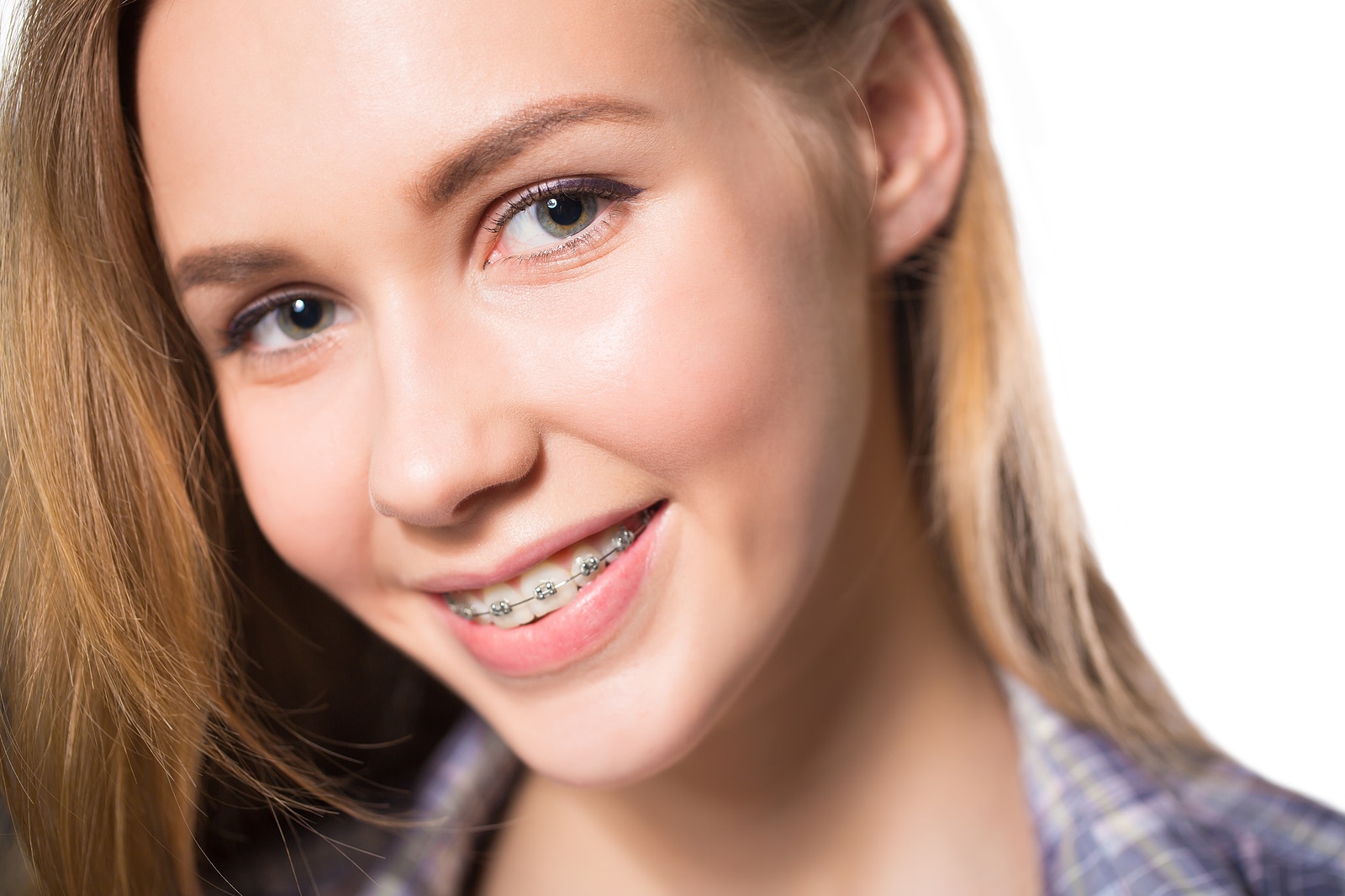 A teenage girl smiling and showing her traditional metal braces during orthodontic treatment.